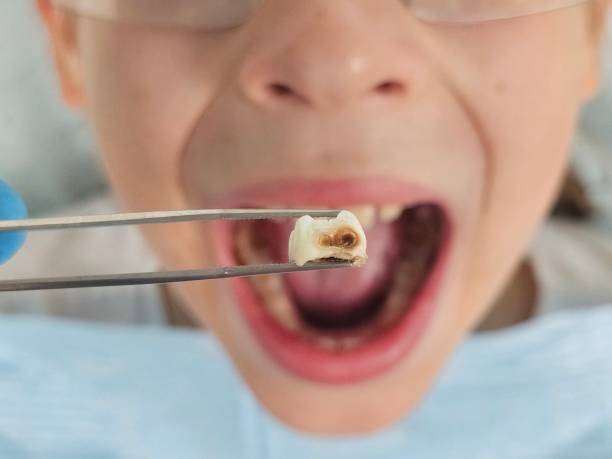 Best Emergency Root Canal Treatment in Paw Paw Lake, MI